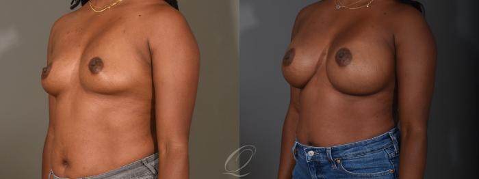 Breast Augmentation Case 1458 Before & After Left Oblique | Serving Rochester, Syracuse & Buffalo, NY | Quatela Center for Plastic Surgery
