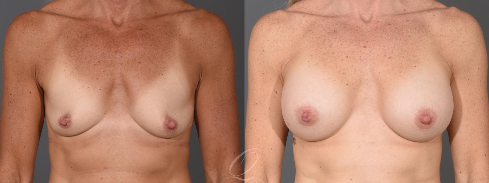 Breast Augmentation Case 1459 Before & After Front | Serving Rochester, Syracuse & Buffalo, NY | Quatela Center for Plastic Surgery