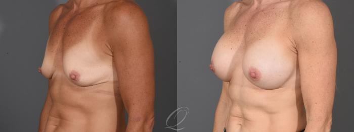 Breast Augmentation Case 1459 Before & After Left Oblique | Serving Rochester, Syracuse & Buffalo, NY | Quatela Center for Plastic Surgery