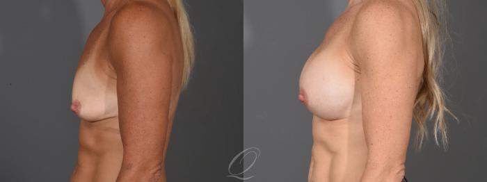 Breast Augmentation Case 1459 Before & After Left Side | Serving Rochester, Syracuse & Buffalo, NY | Quatela Center for Plastic Surgery