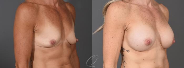 Breast Augmentation Case 1459 Before & After Right Oblique | Serving Rochester, Syracuse & Buffalo, NY | Quatela Center for Plastic Surgery