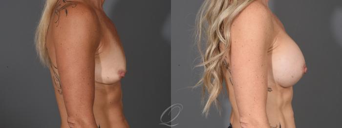 Breast Augmentation Case 1459 Before & After Right Side | Serving Rochester, Syracuse & Buffalo, NY | Quatela Center for Plastic Surgery
