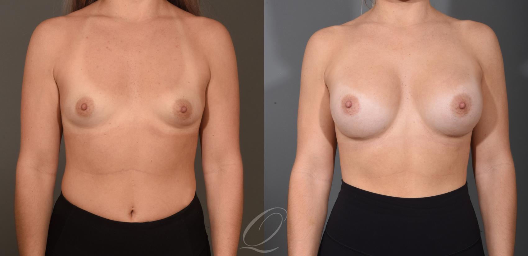 Breast Augmentation Case 1472 Before & After Front | Serving Rochester, Syracuse & Buffalo, NY | Quatela Center for Plastic Surgery