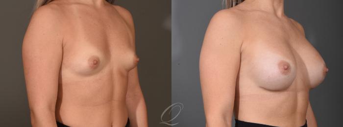 Breast Augmentation Case 1472 Before & After Right Oblique | Serving Rochester, Syracuse & Buffalo, NY | Quatela Center for Plastic Surgery
