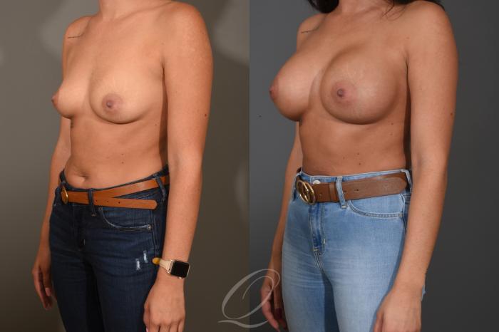 Breast Augmentation Case 1481 Before & After Left Oblique | Serving Rochester, Syracuse & Buffalo, NY | Quatela Center for Plastic Surgery