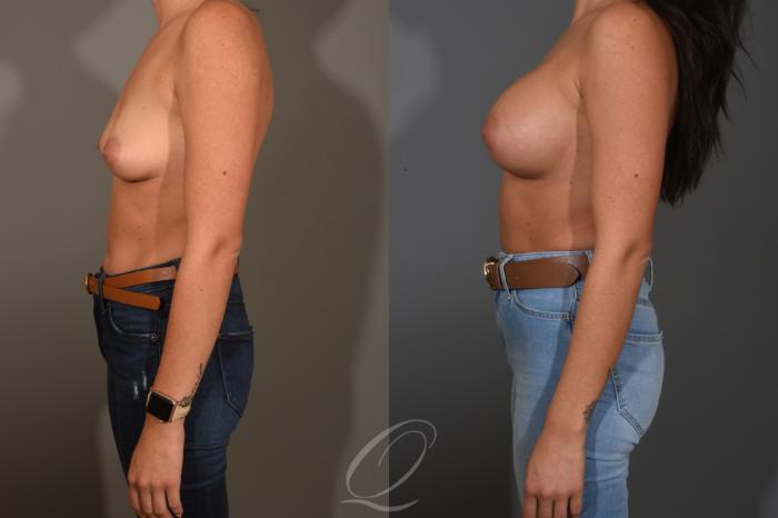 Breast Augmentation Case 1481 Before & After Left Side | Serving Rochester, Syracuse & Buffalo, NY | Quatela Center for Plastic Surgery