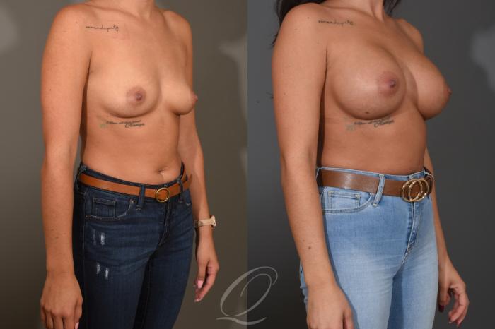 Breast Augmentation Case 1481 Before & After Right Oblique | Serving Rochester, Syracuse & Buffalo, NY | Quatela Center for Plastic Surgery