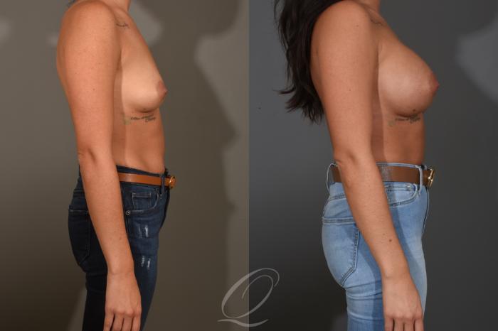 Breast Augmentation Case 1481 Before & After Right Side | Serving Rochester, Syracuse & Buffalo, NY | Quatela Center for Plastic Surgery
