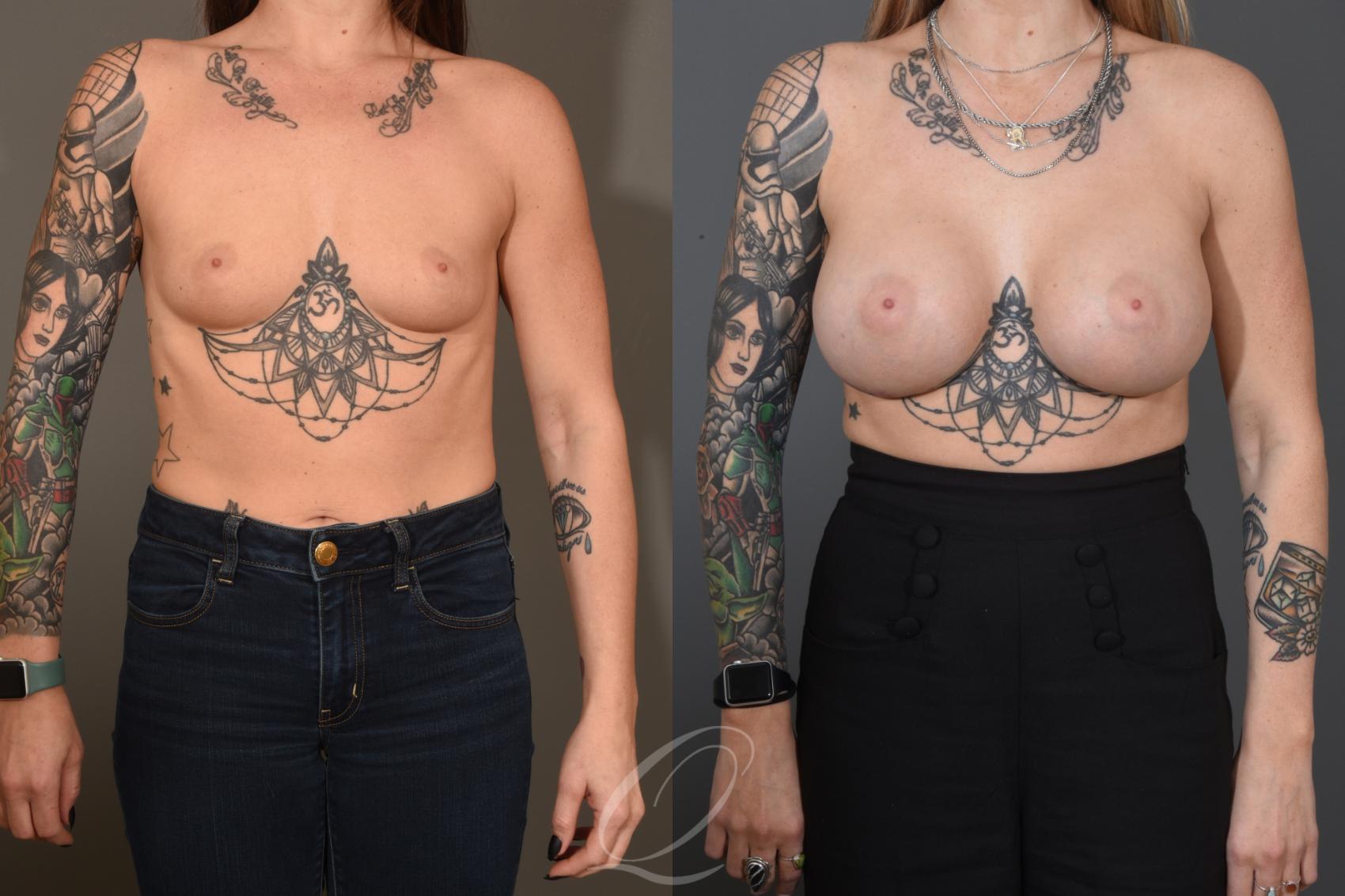 Breast Augmentation Case 1482 Before & After Front | Serving Rochester, Syracuse & Buffalo, NY | Quatela Center for Plastic Surgery