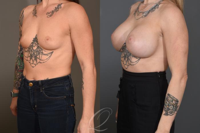 Breast Augmentation Case 1482 Before & After Left Oblique | Serving Rochester, Syracuse & Buffalo, NY | Quatela Center for Plastic Surgery