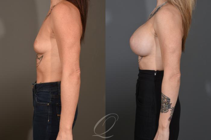 Breast Augmentation Case 1482 Before & After Left Side | Serving Rochester, Syracuse & Buffalo, NY | Quatela Center for Plastic Surgery