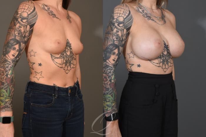 Breast Augmentation Case 1482 Before & After Right Oblique | Serving Rochester, Syracuse & Buffalo, NY | Quatela Center for Plastic Surgery