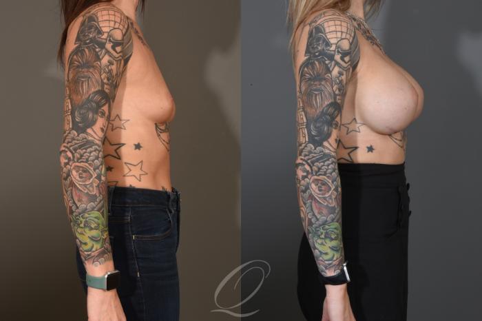 Breast Augmentation Case 1482 Before & After Right Side | Serving Rochester, Syracuse & Buffalo, NY | Quatela Center for Plastic Surgery