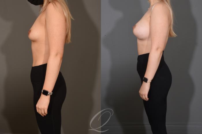 Breast Augmentation Case 1483 Before & After Left Side | Serving Rochester, Syracuse & Buffalo, NY | Quatela Center for Plastic Surgery