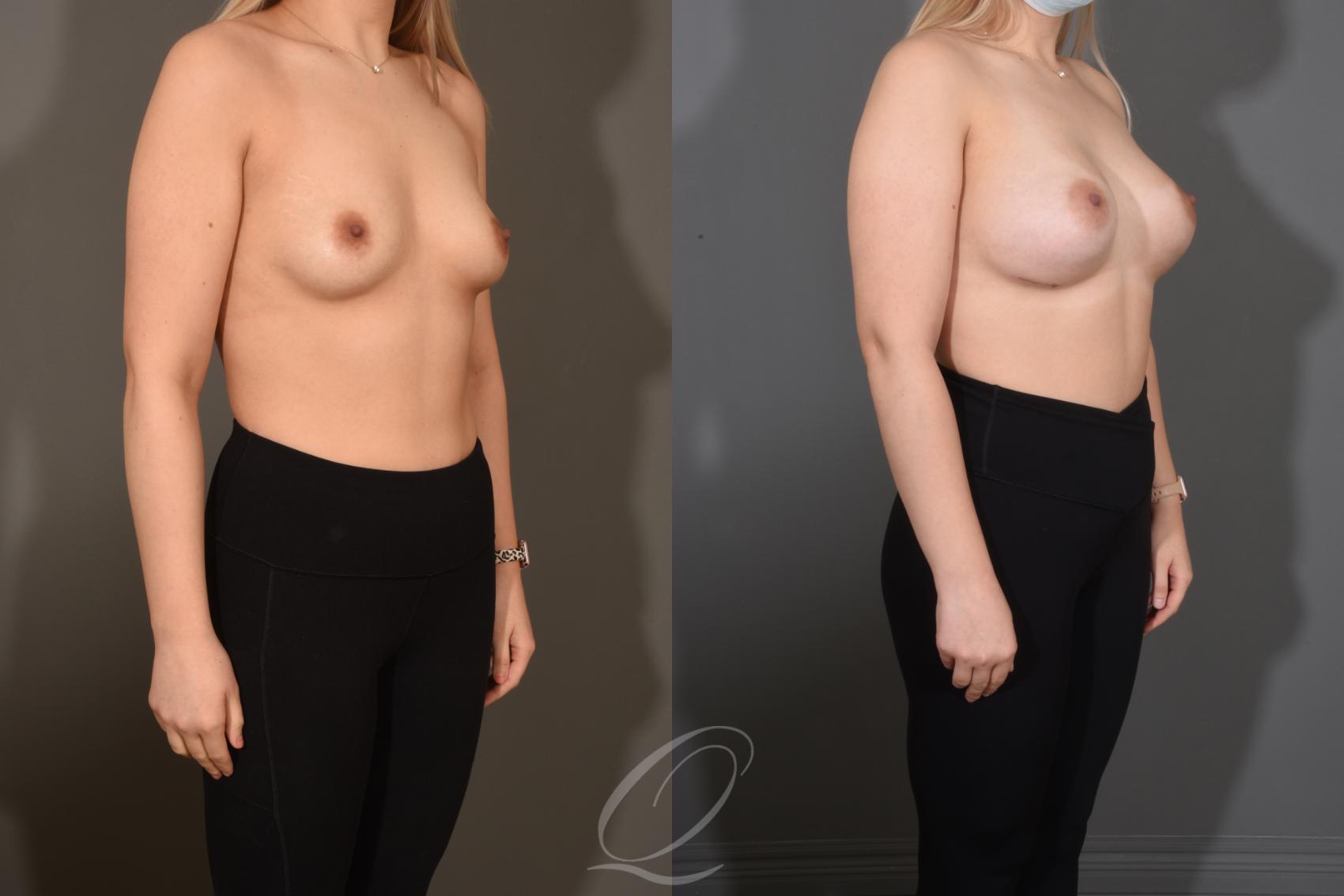 Breast Augmentation Case 1483 Before & After Right Oblique | Serving Rochester, Syracuse & Buffalo, NY | Quatela Center for Plastic Surgery