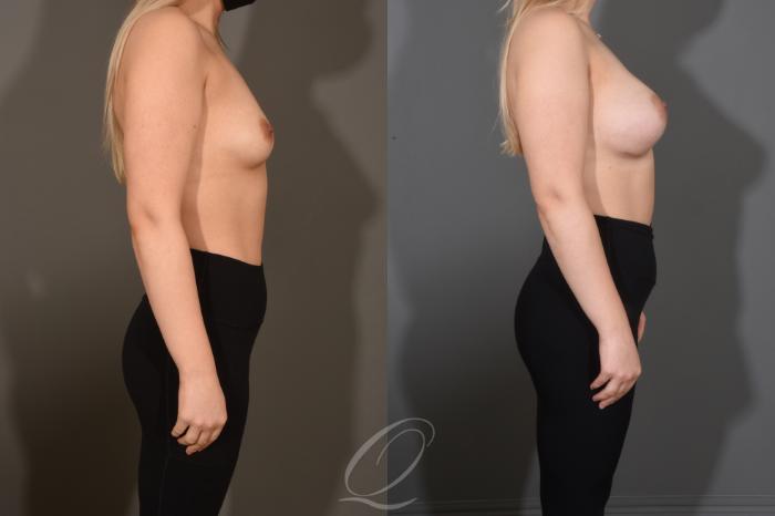 Breast Augmentation Case 1483 Before & After Right Side | Serving Rochester, Syracuse & Buffalo, NY | Quatela Center for Plastic Surgery