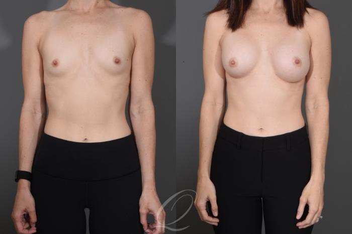 Breast Augmentation Case 1484 Before & After Front | Serving Rochester, Syracuse & Buffalo, NY | Quatela Center for Plastic Surgery