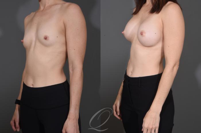 Breast Augmentation Case 1484 Before & After Left Oblique | Serving Rochester, Syracuse & Buffalo, NY | Quatela Center for Plastic Surgery