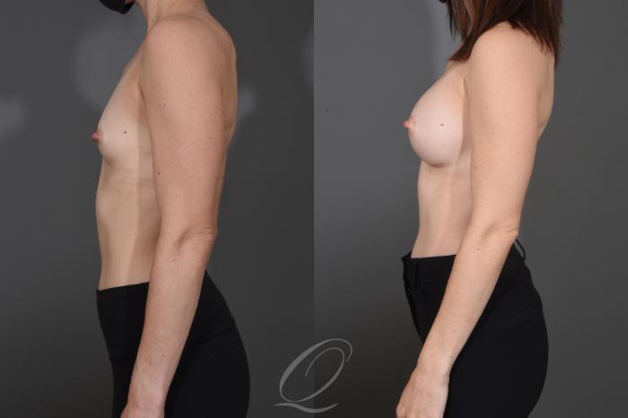 Breast Augmentation Case 1484 Before & After Left Side | Serving Rochester, Syracuse & Buffalo, NY | Quatela Center for Plastic Surgery