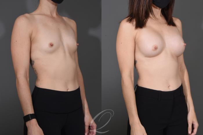 Breast Augmentation Case 1484 Before & After Right Oblique | Serving Rochester, Syracuse & Buffalo, NY | Quatela Center for Plastic Surgery