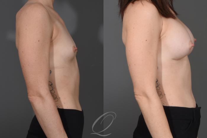 Breast Augmentation Case 1484 Before & After Right Side | Serving Rochester, Syracuse & Buffalo, NY | Quatela Center for Plastic Surgery