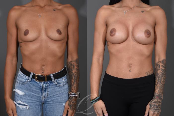 Breast Augmentation Case 1485 Before & After Front | Serving Rochester, Syracuse & Buffalo, NY | Quatela Center for Plastic Surgery