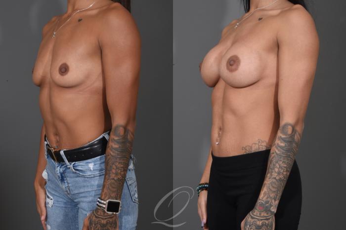 Breast Augmentation Case 1485 Before & After Left Oblique | Serving Rochester, Syracuse & Buffalo, NY | Quatela Center for Plastic Surgery