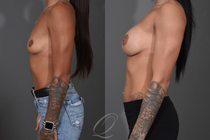 Breast Augmentation Case 1485 Before & After Left Side | Serving Rochester, Syracuse & Buffalo, NY | Quatela Center for Plastic Surgery