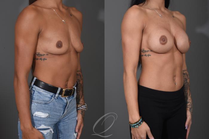 Breast Augmentation Case 1485 Before & After Right Oblique | Serving Rochester, Syracuse & Buffalo, NY | Quatela Center for Plastic Surgery