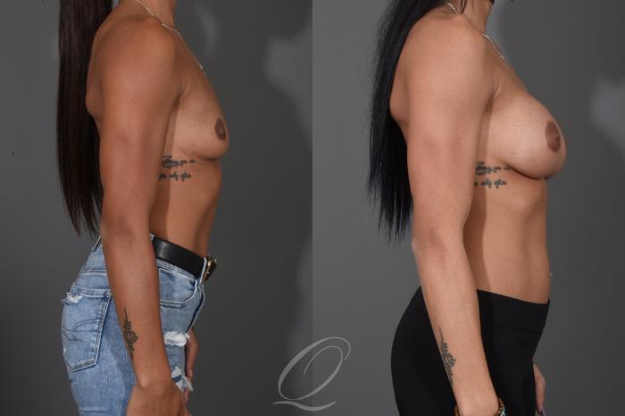 Breast Augmentation Case 1485 Before & After Right Side | Serving Rochester, Syracuse & Buffalo, NY | Quatela Center for Plastic Surgery