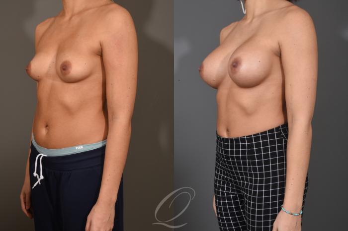 Breast Augmentation Case 1486 Before & After Left Oblique | Serving Rochester, Syracuse & Buffalo, NY | Quatela Center for Plastic Surgery