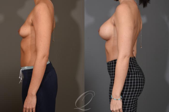 Breast Augmentation Case 1486 Before & After Left Side | Serving Rochester, Syracuse & Buffalo, NY | Quatela Center for Plastic Surgery
