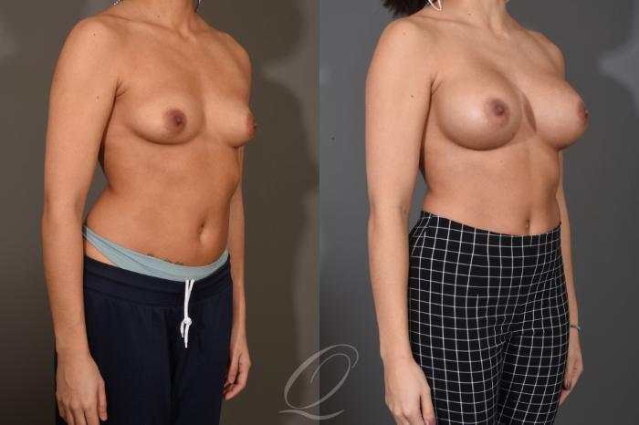 Breast Augmentation Case 1486 Before & After Right Oblique | Serving Rochester, Syracuse & Buffalo, NY | Quatela Center for Plastic Surgery