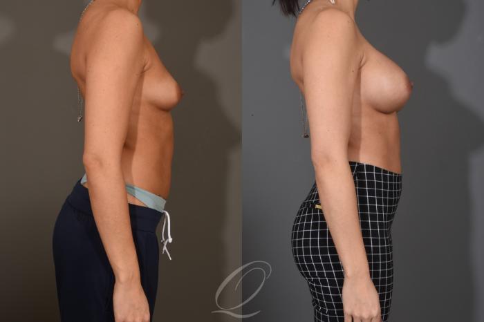 Breast Augmentation Case 1486 Before & After Right Side | Serving Rochester, Syracuse & Buffalo, NY | Quatela Center for Plastic Surgery