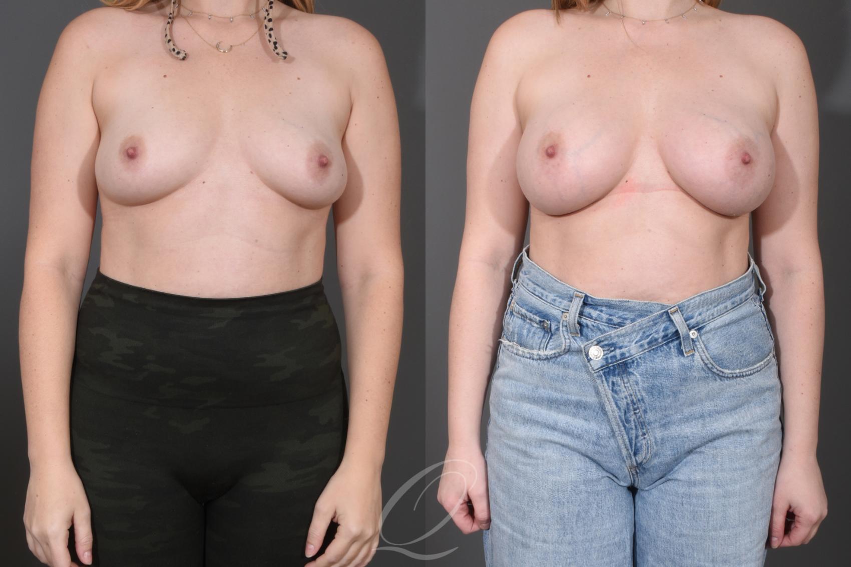 Breast Augmentation Case 1487 Before & After Front | Serving Rochester, Syracuse & Buffalo, NY | Quatela Center for Plastic Surgery