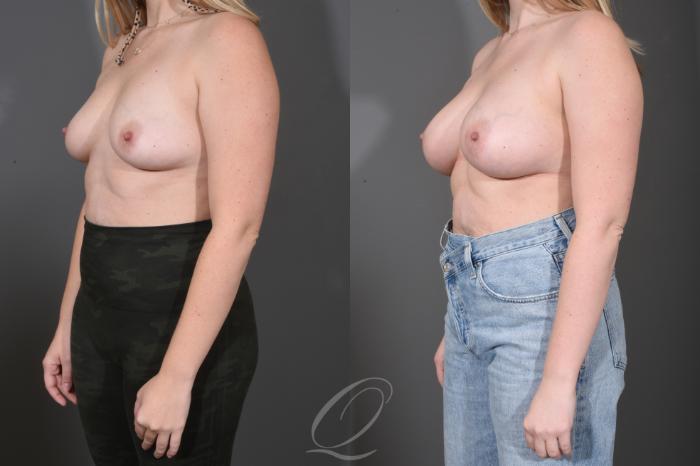 Breast Augmentation Case 1487 Before & After Left Oblique | Serving Rochester, Syracuse & Buffalo, NY | Quatela Center for Plastic Surgery
