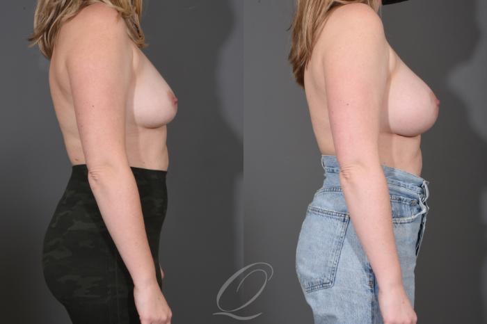 Breast Augmentation Case 1487 Before & After Right Side | Serving Rochester, Syracuse & Buffalo, NY | Quatela Center for Plastic Surgery