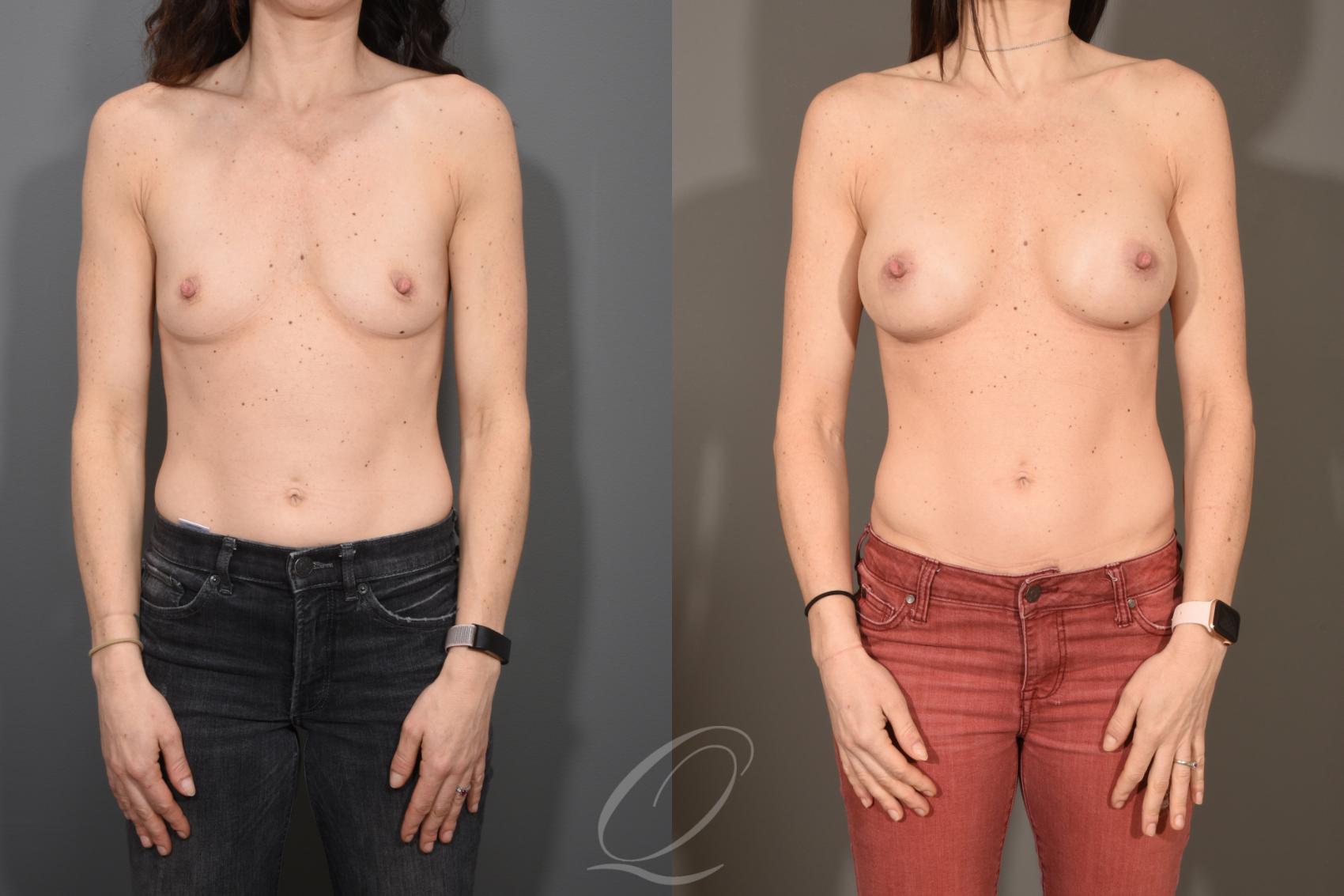 Breast Augmentation Case 1517 Before & After View #1 | Serving Rochester, Syracuse & Buffalo, NY | Quatela Center for Plastic Surgery