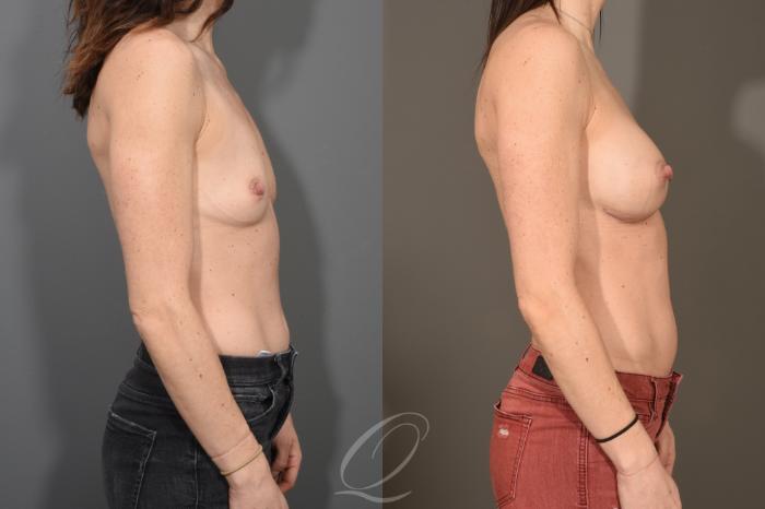 Breast Augmentation Case 1517 Before & After View #3 | Serving Rochester, Syracuse & Buffalo, NY | Quatela Center for Plastic Surgery