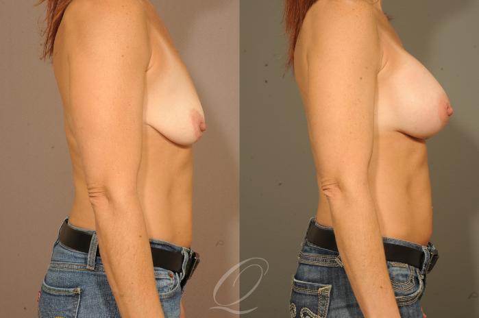 Breast Augmentation Case 1521 Before & After View #3 | Serving Rochester, Syracuse & Buffalo, NY | Quatela Center for Plastic Surgery