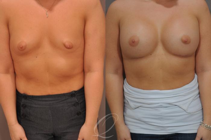 Breast Augmentation Case 1523 Before & After View #1 | Serving Rochester, Syracuse & Buffalo, NY | Quatela Center for Plastic Surgery