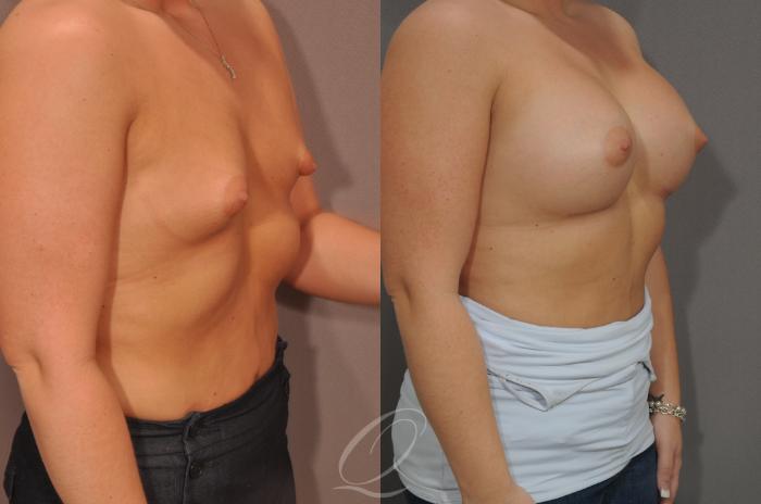 Breast Augmentation Case 1523 Before & After View #2 | Serving Rochester, Syracuse & Buffalo, NY | Quatela Center for Plastic Surgery