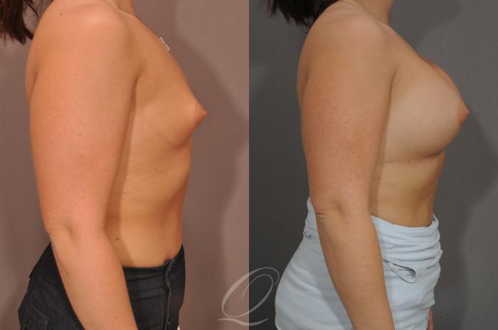 Breast Augmentation Case 1523 Before & After View #3 | Serving Rochester, Syracuse & Buffalo, NY | Quatela Center for Plastic Surgery