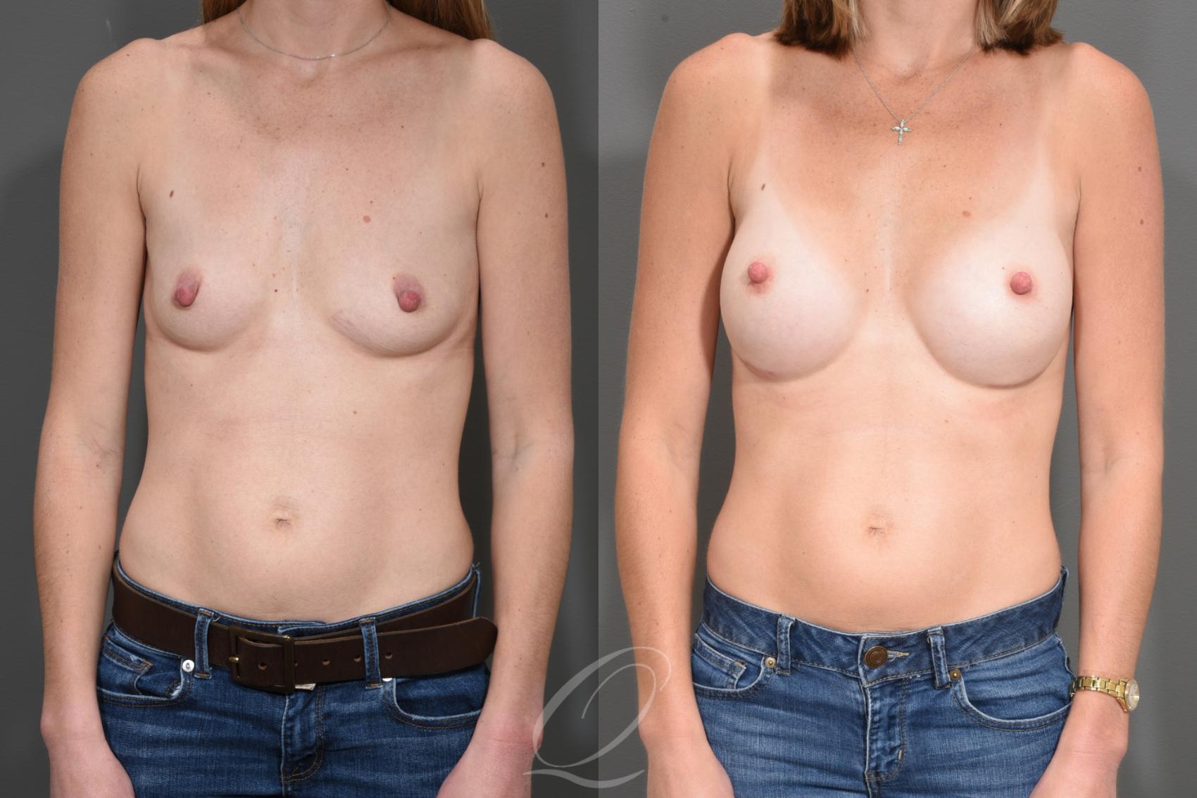Breast Augmentation Case 1526 Before & After Front | Serving Rochester, Syracuse & Buffalo, NY | Quatela Center for Plastic Surgery