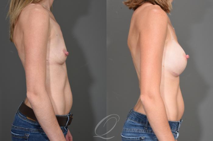 Breast Augmentation Case 1526 Before & After Right Side | Serving Rochester, Syracuse & Buffalo, NY | Quatela Center for Plastic Surgery