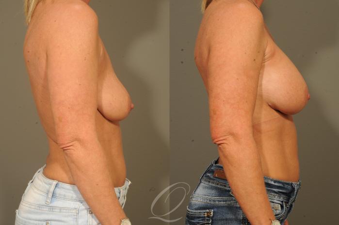 Breast Augmentation Case 1529 Before & After View #3 | Serving Rochester, Syracuse & Buffalo, NY | Quatela Center for Plastic Surgery