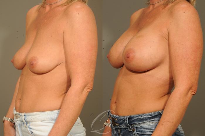 Breast Augmentation Case 1529 Before & After View #4 | Serving Rochester, Syracuse & Buffalo, NY | Quatela Center for Plastic Surgery