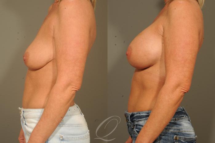 Breast Augmentation Case 1529 Before & After View #5 | Serving Rochester, Syracuse & Buffalo, NY | Quatela Center for Plastic Surgery