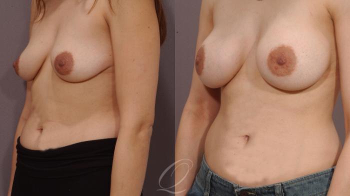 Breast Augmentation Case 182 Before & After View #2 | Serving Rochester, Syracuse & Buffalo, NY | Quatela Center for Plastic Surgery