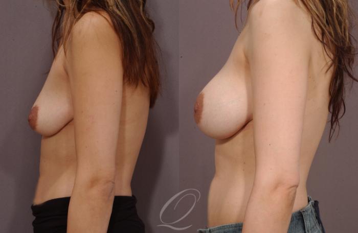 Breast Augmentation Case 182 Before & After View #3 | Serving Rochester, Syracuse & Buffalo, NY | Quatela Center for Plastic Surgery
